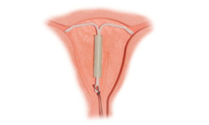 Métodos anticonceptivos femeninos, dispositivo intrauterino